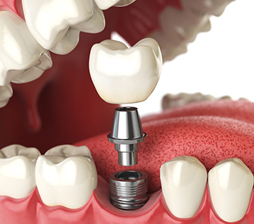 illustration of the dental implant process